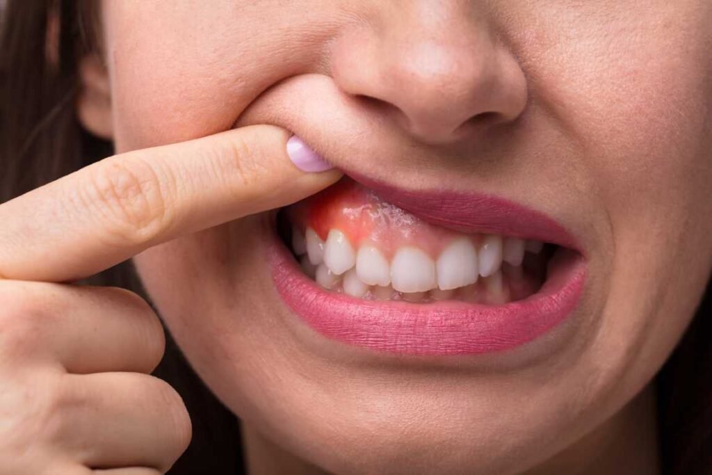 Bleeding or Swollen Gums That Will Not Calm Down